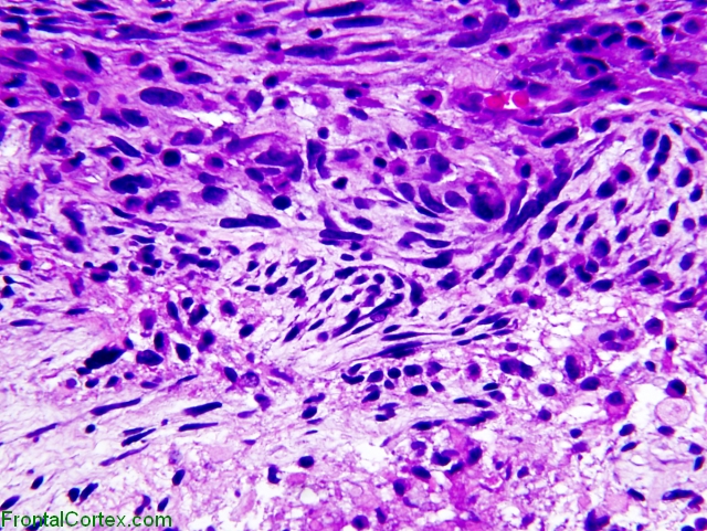 Gliosarcoma , H&E stain x400